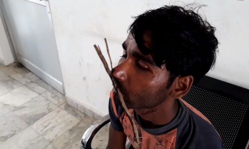 दबंगों ने युवक की नाक में जमीनी विवाद को लेकर लकड़ी घुसेड दी दबंगों ने युवक की नाक में जमीनी विवाद को लेकर लकड़ी घुसेड दी