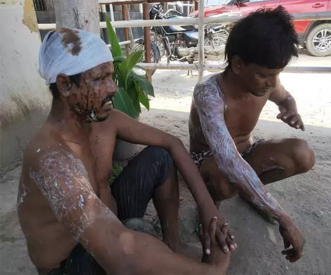 MOBILE विवाद में दबंगों ने ACID फेंका, 16 झुलसे मचा हडकम्प, देखिये वीडियो