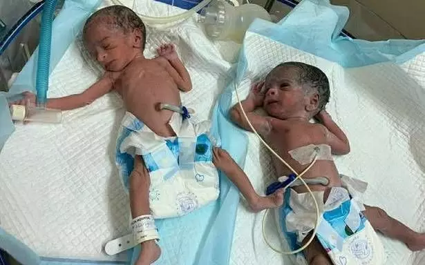 73 वर्षीय महिला ने गुंटूर में दिया जुड़वां बच्चों को जन्म