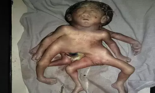 4 हाथ पैर वाले बच्चे ने लिया जन्म,देखने वालों की लगी भीड़, लेकिन... ? 4 हाथ पैर वाले बच्चे ने लिया जन्म,देखने वालों की लगी भीड़, लेकिन... ?