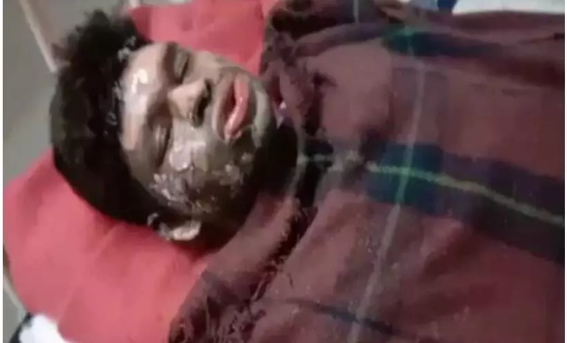 मध्यप्रदेश: सागर में जिंदा जलाए गए दलित युवक धनप्रसाद की इलाज के दौरान दिल्ली के सफदरजंग अस्पताल में मौत मध्यप्रदेश: सागर में जिंदा जलाए गए दलित युवक धनप्रसाद की इलाज के दौरान दिल्ली के सफदरजंग अस्पताल में मौत
