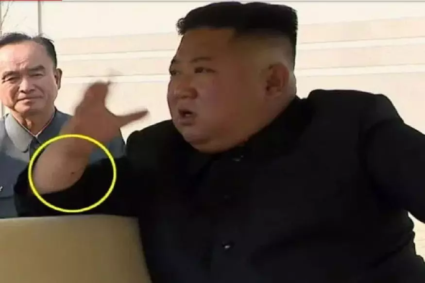 जानिए क्या है नार्थ कोरिया के तानाशाह की हथेली पर बने इस निशान का राज़, जानकर हो जाएंगे हैरान