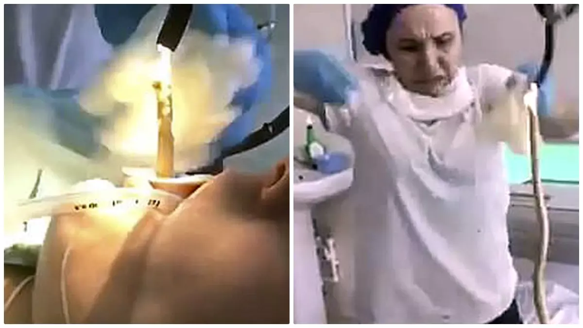महिला के मुंह से 4 फीट लंबा सांप निकला, डॉक्टरों के छूटे पसीने