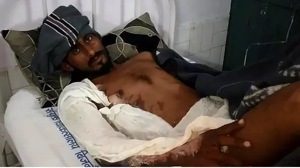 शादी समारोह में पानी को लेकर हुए विवाद में फेंका खुलता खौलता हुआ तेल और फिर हुआ ये हाल शादी समारोह में पानी को लेकर हुए विवाद में फेंका खुलता खौलता हुआ तेल और फिर हुआ ये हाल
