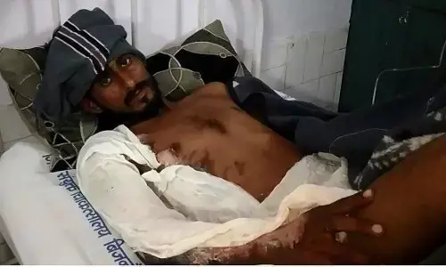 शादी समारोह में पानी को लेकर हुए विवाद में फेंका खुलता खौलता हुआ तेल और फिर हुआ ये हाल शादी समारोह में पानी को लेकर हुए विवाद में फेंका खुलता खौलता हुआ तेल और फिर हुआ ये हाल