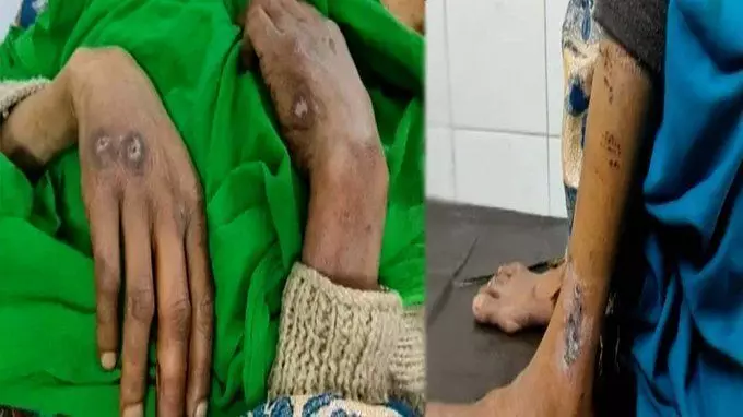 दहेज के लालची पति क्रूरता की सारी हदें पार, पत्नी के खाना मांगने पर कुत्ते से कटवाया! दहेज के लालची पति क्रूरता की सारी हदें पार, पत्नी के खाना मांगने पर कुत्ते से कटवाया!