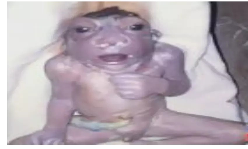 महिला ने दिया विचित्र शिशु को जन्म, पैदा होते ही हुई मौत