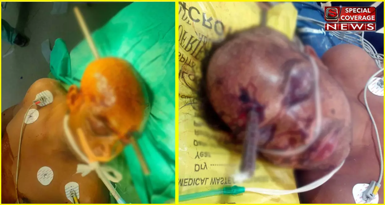 गाजियाबाद : सिर के आर-पार हुआ सरिया, ऐसा हाल देखकर डॉ के भी छूटे पसीने! तस्वीरें देखकर कांप जाएंगे गाजियाबाद : सिर के आर-पार हुआ सरिया, ऐसा हाल देखकर डॉ के भी छूटे पसीने! तस्वीरें देखकर कांप जाएंगे