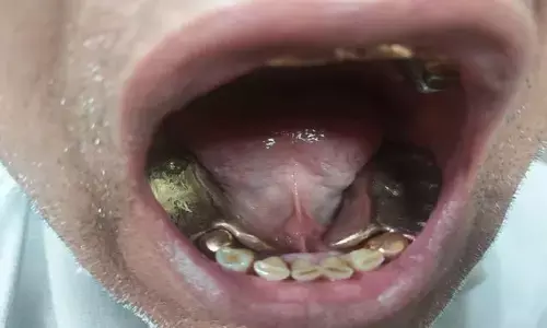 सोने की तस्करी का अनोखा मामला : मुंह में 45 लाख का सोना लेकर दुबई से दिल्ली पहुंचे 2 लोग, कस्टम ने दबोचा सोने की तस्करी का अनोखा मामला : मुंह में 45 लाख का सोना लेकर दुबई से दिल्ली पहुंचे 2 लोग, कस्टम ने दबोचा