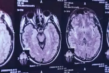 कोरोना के बाद अब रहस्यमई बीमारी के चलते कनाडा में 6 मरे, 50 से अधिक की हालत गंभीर