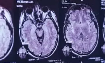 कोरोना के बाद अब रहस्यमई बीमारी के चलते कनाडा में 6 मरे, 50 से अधिक की हालत गंभीर