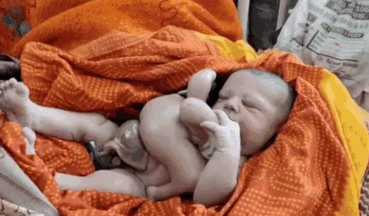 4 हाथ-पैर वाले बच्चे का हुआ जन्म, लेकिन लोगों ने क्या कहा जानें ?