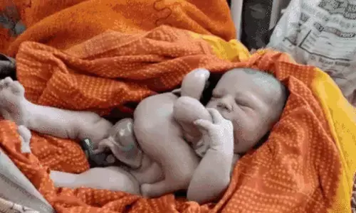 4 हाथ-पैर वाले बच्चे का हुआ जन्म, लेकिन लोगों ने क्या कहा जानें ? 4 हाथ-पैर वाले बच्चे का हुआ जन्म, लेकिन लोगों ने क्या कहा जानें ?