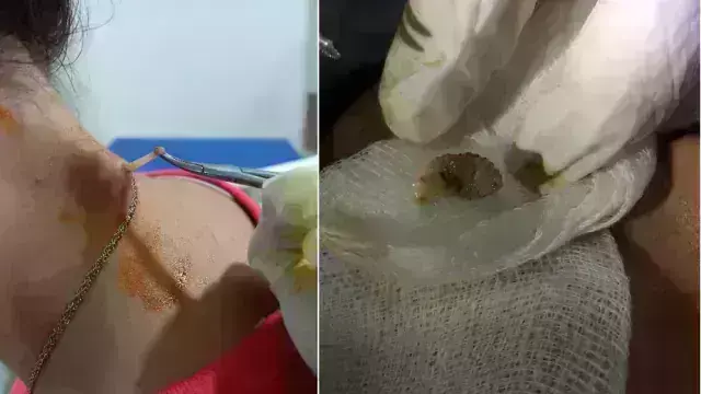 दिल्ली में हुई अमेरिका महिला की सर्जरी, शरीर से निकाले गए तीन जिंदा कीड़े