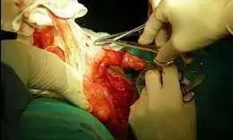 लड़का से लड़की बनाने के लिए दो छात्रों ने यूट्यूब देख कर दी सर्जरी, फिर....मरीज की... लड़का से लड़की बनाने के लिए दो छात्रों ने यूट्यूब देख कर दी सर्जरी, फिर....मरीज की...