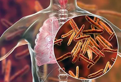 drug-resistant TB: दवा-प्रतिरोधक टीबी: क्या नवीनतम जाँच-इलाज सभी जरूरतमंदों तक पहुँच रहे हैं?