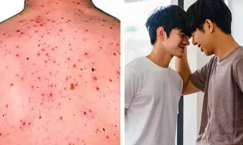 मंकी पॉक्स हुआ तो लोग शक करेंगे कि आप होमो सेक्सुअल तो नहीं!