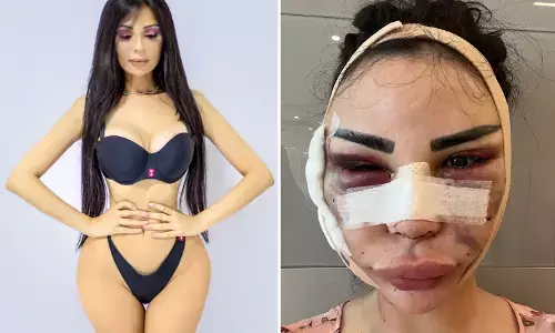 4 рдХрд░реЛреЬ рд░реВ рд╕реЗ рдЬреНрдпрд╛рджрд╛ рдЦрд░реНрдЪ рдХрд░ рдЗрд╕ рдореЙрдбрд▓ рдиреЗ рдмрдирд╛ рд▓рд┐рдпрд╛ рдХрд┐рдо рдХрд╛рд░реНрджрд╢рд┐рдпрди рдЬреИрд╕рд╛ рдЪреЗрд╣рд░рд╛, рдЕрдм рд╣реБрдЖ рдРрд╕рд╛ рд╣рд╛рд▓ рдХрд┐.... 4 рдХрд░реЛреЬ рд░реВ рд╕реЗ рдЬреНрдпрд╛рджрд╛ рдЦрд░реНрдЪ рдХрд░ рдЗрд╕ рдореЙрдбрд▓ рдиреЗ рдмрдирд╛ рд▓рд┐рдпрд╛ рдХрд┐рдо рдХрд╛рд░реНрджрд╢рд┐рдпрди рдЬреИрд╕рд╛ рдЪреЗрд╣рд░рд╛, рдЕрдм рд╣реБрдЖ рдРрд╕рд╛ рд╣рд╛рд▓ рдХрд┐....