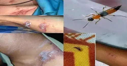 होशियार:  सिक्किम और बंगाल के बाद बिहार में नैरोबी मक्खी का आक्रमण हुआ शुरू, आंख पर बैठे तो चली जाती है आँख की रोशनी होशियार:  सिक्किम और बंगाल के बाद बिहार में नैरोबी मक्खी का आक्रमण हुआ शुरू, आंख पर बैठे तो चली जाती है आँख की रोशनी