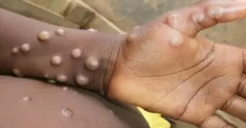 Monkeypox Case: दिल्ली में मिला मंकीपॉक्स का पहला मरीज, मौलाना आजाद मेडिकल कॉलेज में भर्ती Monkeypox Case: दिल्ली में मिला मंकीपॉक्स का पहला मरीज, मौलाना आजाद मेडिकल कॉलेज में भर्ती