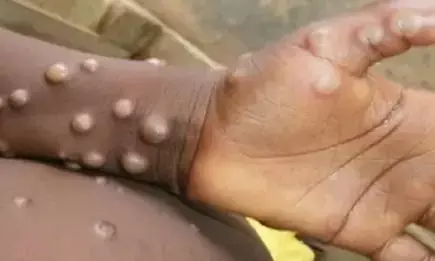 Monkeypox Case: दिल्ली में मिला मंकीपॉक्स का पहला मरीज, मौलाना आजाद मेडिकल कॉलेज में भर्ती Monkeypox Case: दिल्ली में मिला मंकीपॉक्स का पहला मरीज, मौलाना आजाद मेडिकल कॉलेज में भर्ती