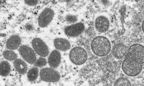 Monkeypox के लक्षण वाले अंतरराष्ट्रीय यात्री दिल्ली एयरपोर्ट से सीधे भेजे जाएंगे LNJP अस्पताल, अलर्ट पर केरल-तेलंगाना