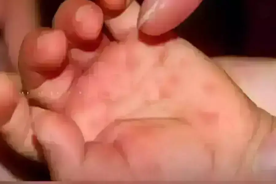 рд░рд╛рдЬрдзрд╛рдиреА рд▓рдЦрдирдК рдореЗ рдЯреЛрдореИрдЯреЛ рдлреНрд▓реВ рдХреЗ 12 рдмрдЪреНрдЪреЛрдВ рдореЗрдВ рдкрд╛рдП рдЧрдП рд▓рдХреНрд╖рдг рд░рд╛рдЬрдзрд╛рдиреА рд▓рдЦрдирдК рдореЗ рдЯреЛрдореИрдЯреЛ рдлреНрд▓реВ рдХреЗ 12 рдмрдЪреНрдЪреЛрдВ рдореЗрдВ рдкрд╛рдП рдЧрдП рд▓рдХреНрд╖рдг