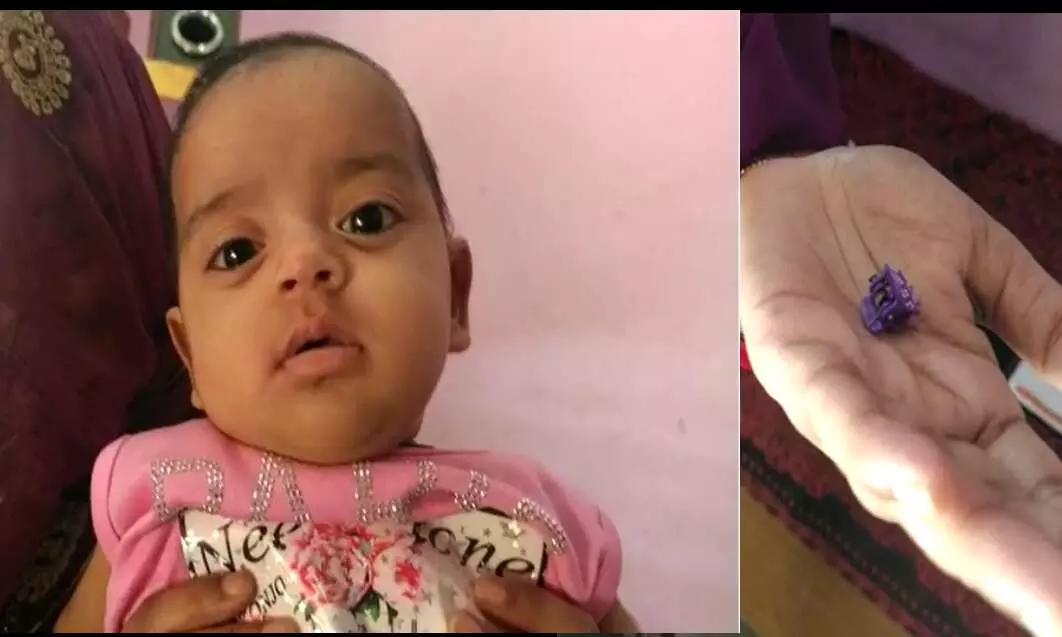 गाजियाबाद : 5 महीने की रिया ने खेलते समय बालों में लगाने वाले क्लेचर को निगल लिया