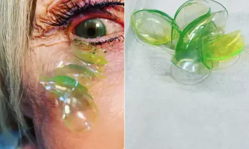 होश उड़ाने वाला VIDEO : डॉक्टर ने महिला की आंख से निकाले 23 कॉन्टैक्ट लेंस, वजह जान उड़ जाएंगे होश होश उड़ाने वाला VIDEO : डॉक्टर ने महिला की आंख से निकाले 23 कॉन्टैक्ट लेंस, वजह जान उड़ जाएंगे होश