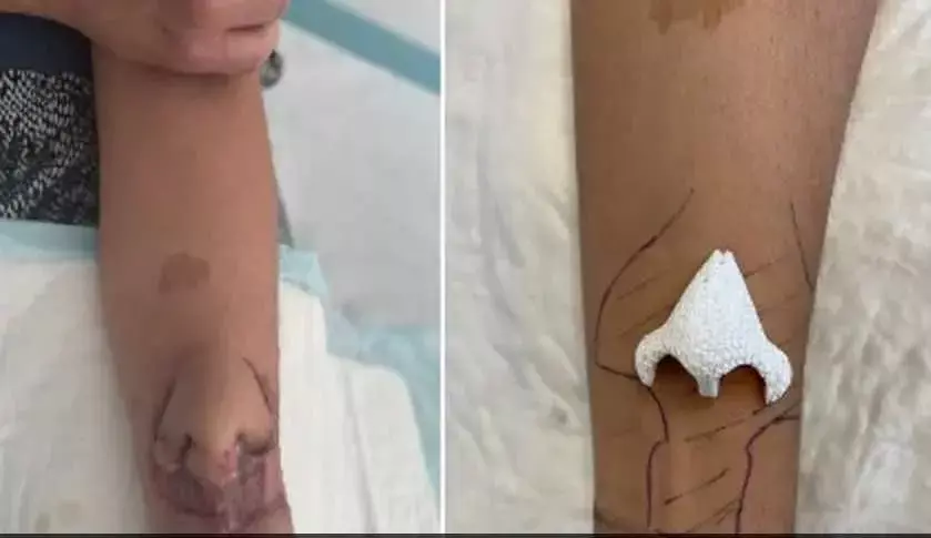 महिला के हाँथ पर डॉक्टर्स ने नाक उगाई, हुआ चमत्कार महिला के हाँथ पर डॉक्टर्स ने नाक उगाई, हुआ चमत्कार