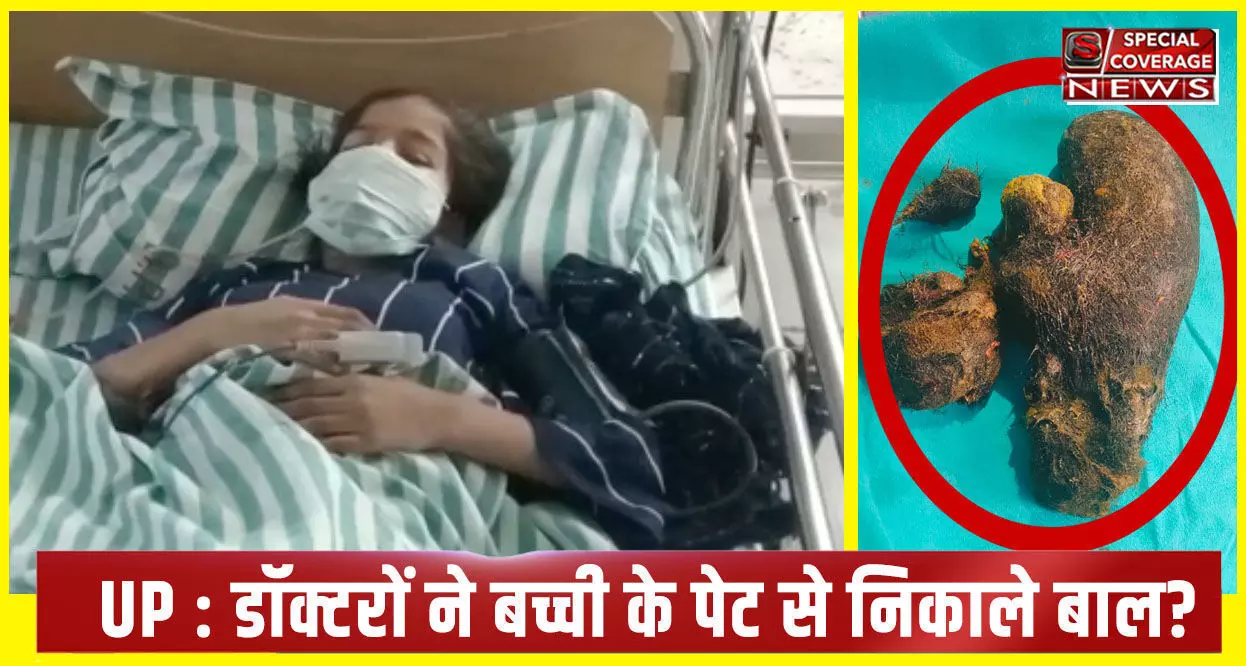 Shocking! जब डॉक्टरों ने बच्ची के पेट से निकाला 2 किलो से ज्यादा बालों का गुच्छा, देखिए- होश उड़ाने वाला वीडियो