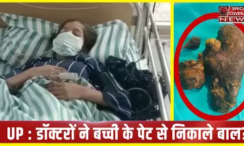 Shocking! जब डॉक्टरों ने बच्ची के पेट से निकाला 2 किलो से ज्यादा बालों का गुच्छा, देखिए- होश उड़ाने वाला वीडियो
