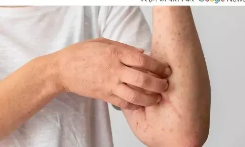 एक्जिमा: क्या आपके भी शरीर में होती है खुजली?? आपको भी है एग्जिमा की शिकायत, तो अपनाएं ये घरेलू उपचार, तुरंत मिलेगी राहत