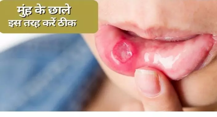Mouth Ulcer: मुंह के छालों को दूर करना अब हुआ बेहद आसान, करे यह असरदार उपाय, मुंह के छालों को करें बाय-बाय