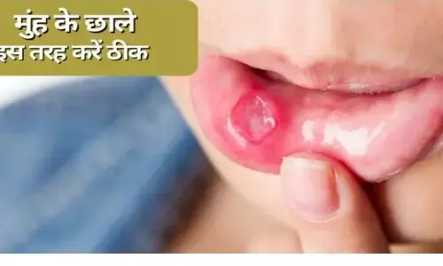 Mouth Ulcer: मुंह के छालों को दूर करना अब हुआ बेहद आसान, करे यह असरदार उपाय, मुंह के छालों को करें बाय-बाय