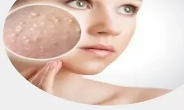 अगर आपको भी चाहिए दमकता हुआ पिंपल फ्री चेहरा तो चेहरे पर अपनाएं ये नुस्खे