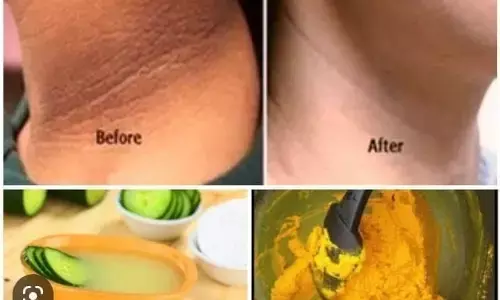 अगर पसीने और गर्मी से काली गर्दन बन गई है आपकी समस्या तो यूं करें समाधान