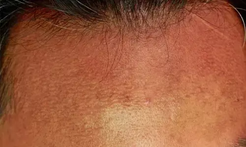 अगर आपके माथे पर भी टैनिंग से आ गया है कालापन, तो लगाइए यह चीजें अगर आपके माथे पर भी टैनिंग से आ गया है कालापन, तो लगाइए यह चीजें