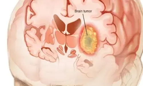 अनलॉकिंग द मिस्ट्री: डॉक्टर ने ब्रेन ट्यूमर के पीछे के 5 संभावित कारणों का किया खुलासा