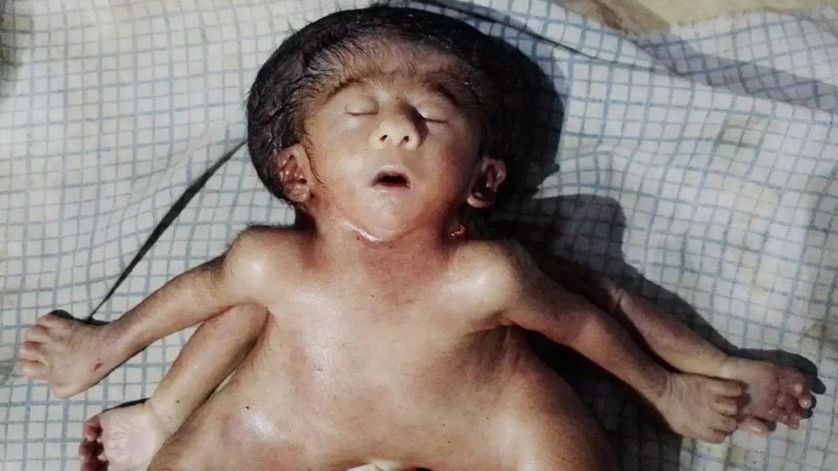 विचित्र बच्ची को देख सकते में लोग... 4 हाथ, 4 पैर, 2 दिल और एक सिर...बिहार के नर्सिंग होम में हुई पैदा विचित्र बच्ची को देख सकते में लोग... 4 हाथ, 4 पैर, 2 दिल और एक सिर...बिहार के नर्सिंग होम में हुई पैदा