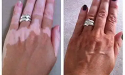 विटिलिगो: आपको इसके बारे में क्या जानना चाहिए?