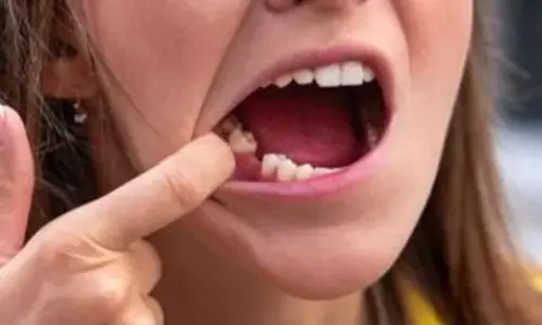 युवा वयस्कों में दांतों का टूटना: क्या आपकी मुस्कान खतरे में है?