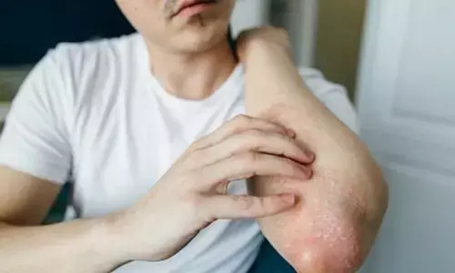 मानसून के दौरान फंगल संक्रमण से कैसे बचें?