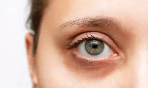 डार्क सर्कल उपचार: अपनी आंखों को काले धब्बों से बचाएं,अपनाये ये टिप्स