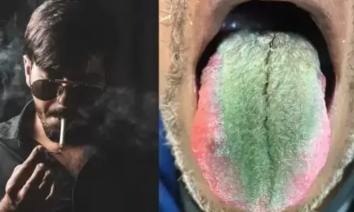 धूम्रपान की लत के कारण आदमी की जीभ पर उग आए हरे बाल