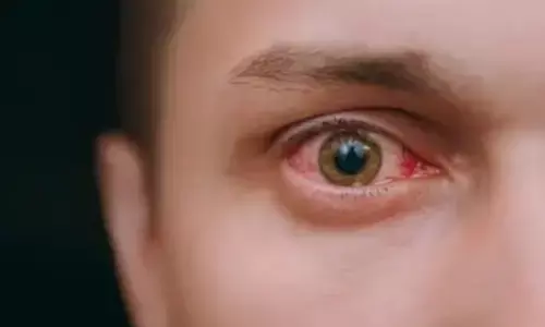 पिंक आई कितनी गंभीर है? जानिए संकेत, लक्षण और बचाव के उपाय पिंक आई कितनी गंभीर है? जानिए संकेत, लक्षण और बचाव के उपाय