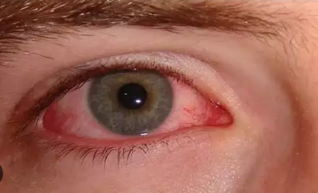 बाढ़ के बाद, नोएडा जिला अस्पताल में प्रतिदिन 200-250 नेत्रश्लेष्मलाशोथ के आ रहे हैं मामले