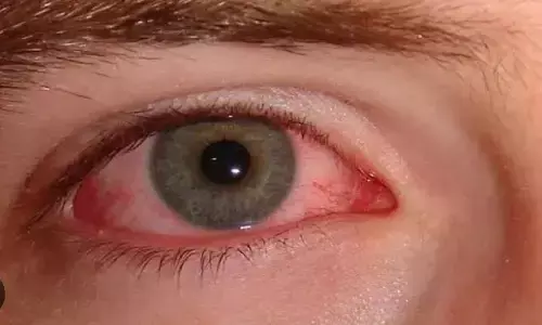 बाढ़ के बाद, नोएडा जिला अस्पताल में प्रतिदिन 200-250 नेत्रश्लेष्मलाशोथ के आ रहे हैं मामले बाढ़ के बाद, नोएडा जिला अस्पताल में प्रतिदिन 200-250 नेत्रश्लेष्मलाशोथ के आ रहे हैं मामले