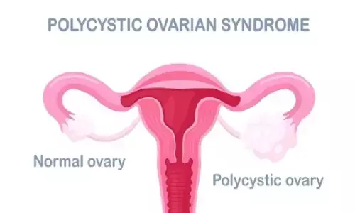 अब अपने पीसीओडी पर रखें नियंत्रण,आज़माएं इन आदतों को