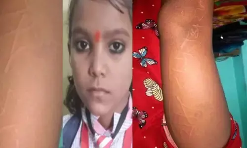 Words Ram-Ram and Radhe-Radhe emerging on the girls body, even doctors are surprised Words Ram-Ram and Radhe-Radhe emerging on the girls body, even doctors are surprised